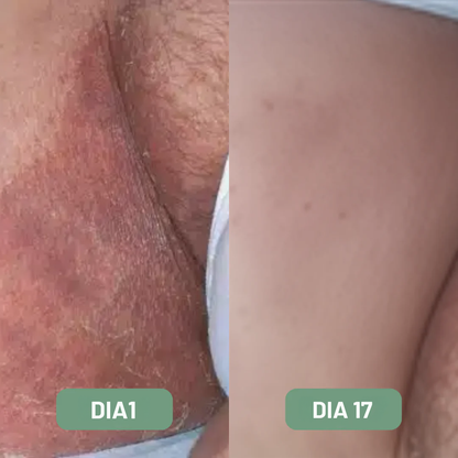 Jabón antimicótico Alivera® Anti Tiña Inguinal - Formula natural antifúngica.