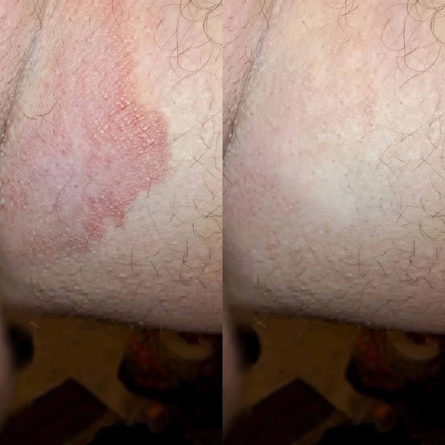 Jabón antimicótico Alivera® Anti Tiña Inguinal - Formula natural antifúngica.